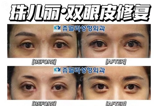 韩国珠儿丽双眼皮修复对比图