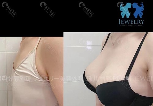 韩国珠儿丽整形外科假体隆胸对比图