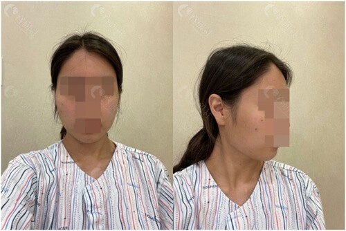 在韩国1%整形外科医院做面部轮廓手术前照片