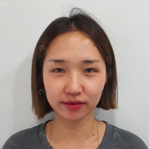韩国双眼皮修复术前