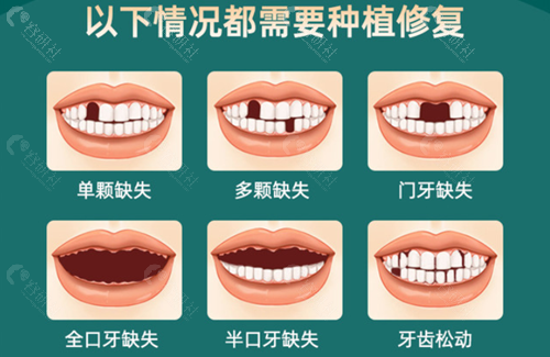 北京怀柔区种植牙价格表