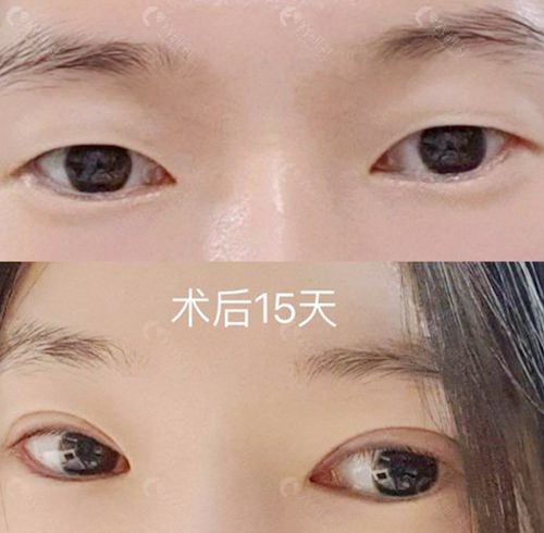 韩国做双眼皮技术好的爱护EH整形外科朴炳浩切开双眼皮+眼肌矫正术前和术后15天
