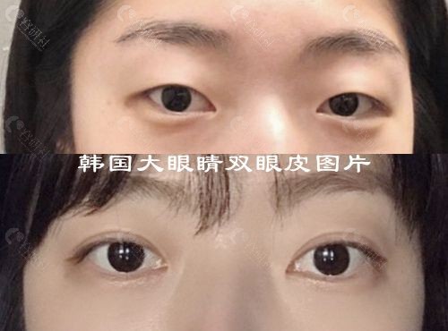 韩国做双眼皮技术好的大眼睛整形外科高汉雄院长双眼皮对比图