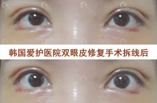 韩国爱护医院双眼皮修复手术拆线后