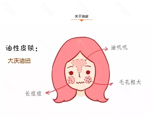 油性皮肤长痘痘.jpg