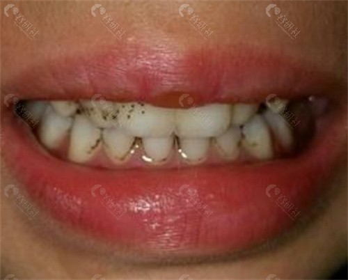  牙齿变的凹凸不平，使用牙齿表面粗糙