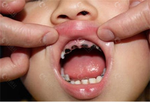 牙齿上面会出现黑色斑点，个别会有小洞