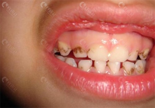 牙齿开始变黄，和正常牙齿明显有色差