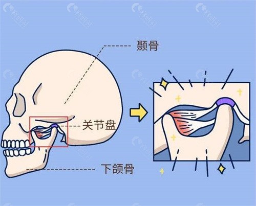 北大深圳医院杨辉俊下颌角手术多少钱？