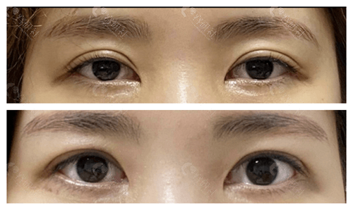 爱护整形医院双眼皮修复对比