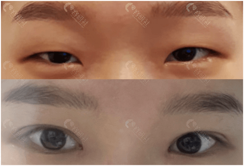 韩国爱护整形医院双眼皮实例
