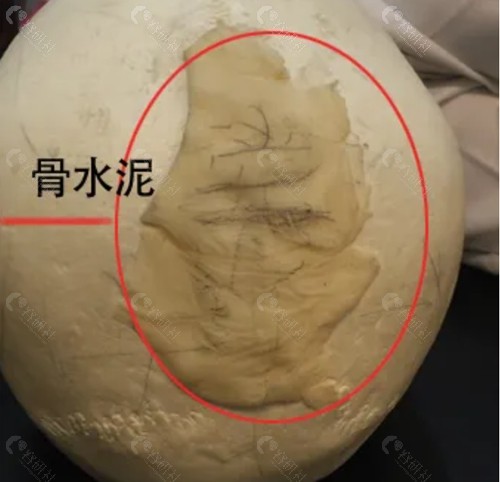 骨水泥增高颅顶失败 