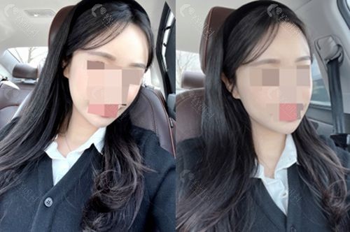 韩国1%整形外科面部轮廓三件套术后7个月照片