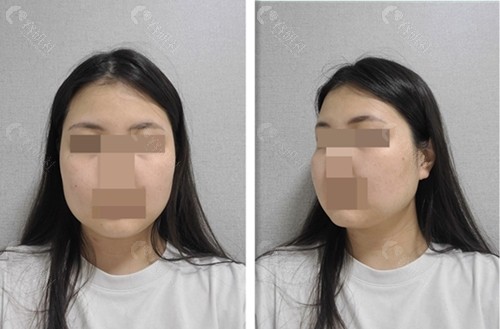 韩国1%整形外科做面部轮廓术前照片