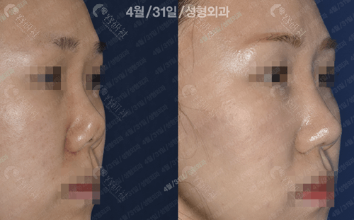 韩国431整形外科鼻修复侧面对比