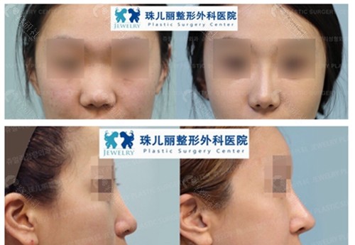 韩国珠儿丽整形外科假体隆鼻对比图