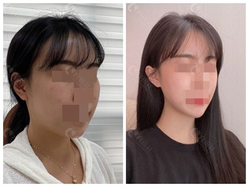 韩国轮廓手术最好的医生排名 下颌角 颧骨内推这几位不踩雷 爱美容研社