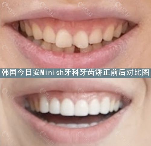 韩国今日安Minish牙科牙齿矫正前后对比图