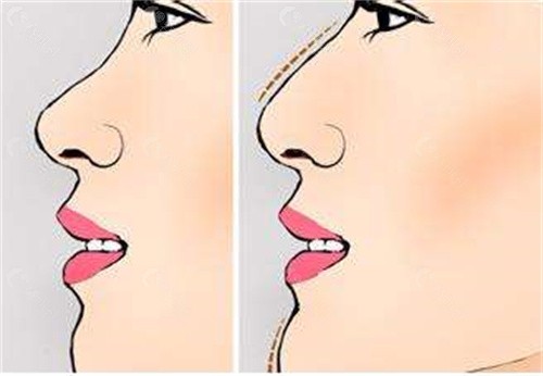 任东医生做鼻子整形求美者反馈怎么样？