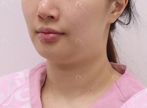 韩国俪伴整形外科医院面部吸脂+提拉手术前照片