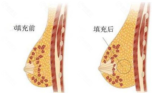 crt丰胸手术有哪些优势？