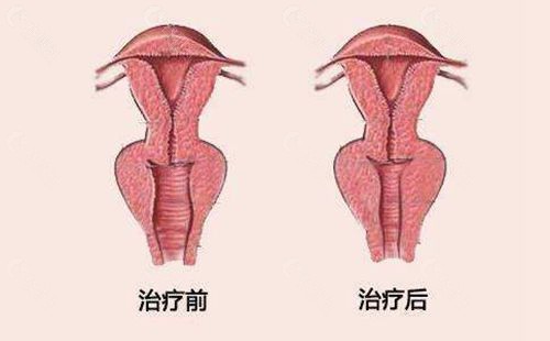 私密紧缩手术治疗前后对比