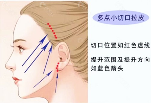 北京黄寺拉皮技术介绍