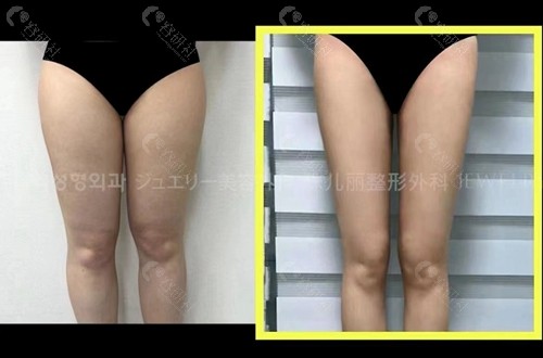 韩国珠儿丽整形外科大腿吸脂