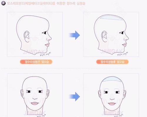 韩国雕刻整形医院头顶整形模拟图