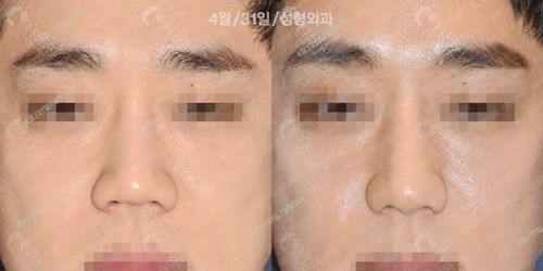 韩国4月31日整形外科初鼻手术实例一