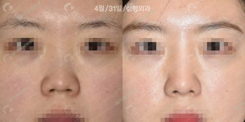 韩国4月31日整形外科初鼻手术实例二