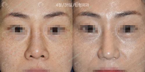 韩国4月31日整形外科初鼻手术实例三