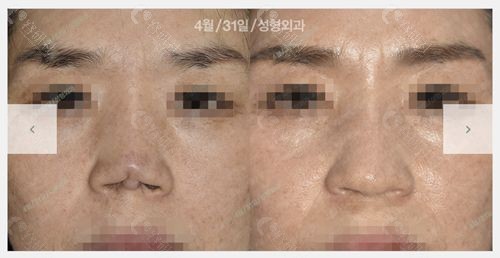 韩国4月31日整形外科初鼻手术实例四
