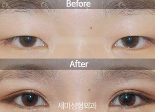 韩国世美SEMI整形外科朴相炫院长双眼皮整形前后对比图