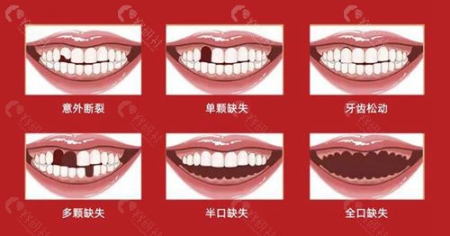 牙齿缺失