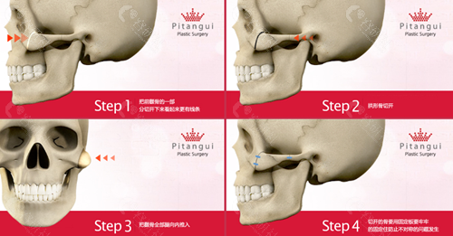 必当归医院颧骨缩小手术方法