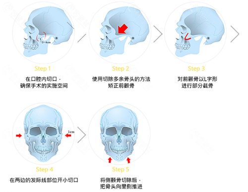 珠儿丽整形外科颧骨缩小手术方法