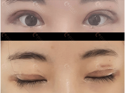 韩国爱护整形医院眼修复术前照片
