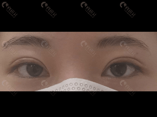 韩国爱护整形医院眼修复术后