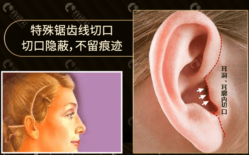 拉皮除皱手术切口