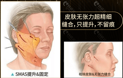 拉皮除皱手术缝合特色