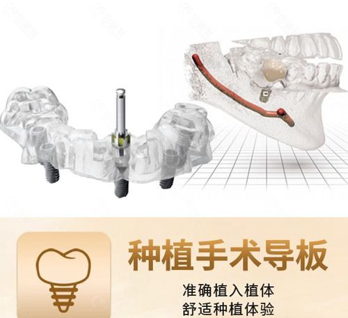 长沙星沙雅贝康口腔种植牙技术
