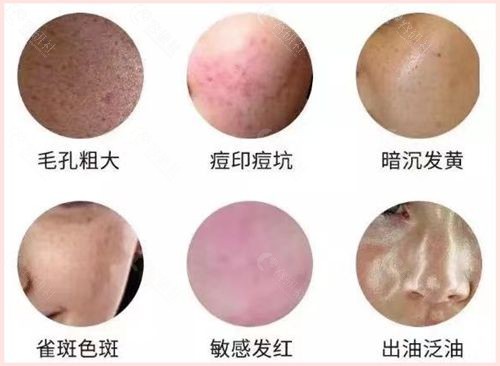 K8舒敏之星抗敏修复可以改善皮肤哪些问题？
