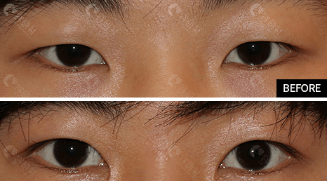 韩国爱护割双眼皮对比照
