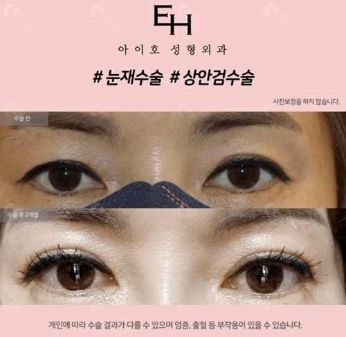 韩国爱护割双眼皮对比照