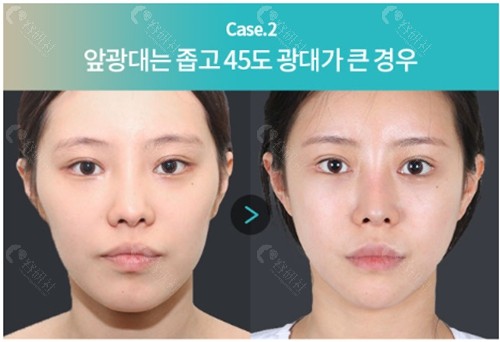 韩国TS整形外科轮廓整形前后对比照