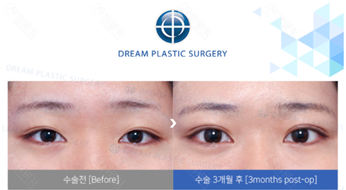 韩国梦想整形外科医院眼部整形对比照