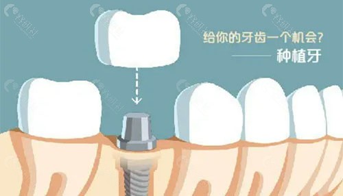 北京圣贝口腔种植牙贵吗？