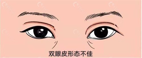 北京马力做双眼皮修复求美者反馈好不好？
