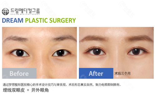韩国梦想整形外科医院双眼皮整形对比图